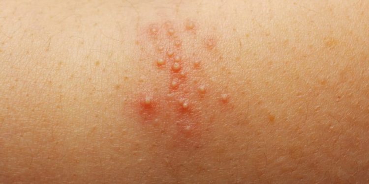Hitzepickel im Sommer: Ursachen, Prävention und Behandlung