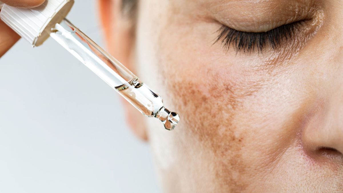 5 Tipps bei Hyperpigmentierung