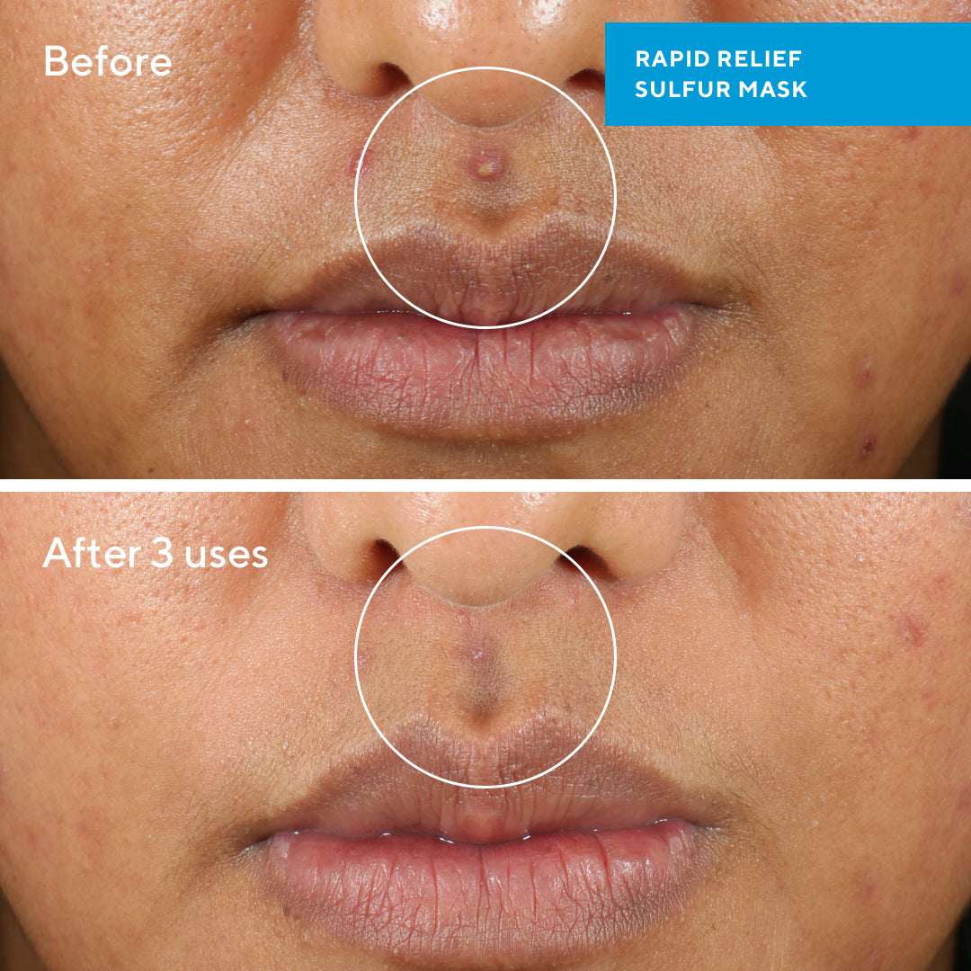 Murad BLEMISH CONTROL - RAPID RELIEF SULFUR MASK