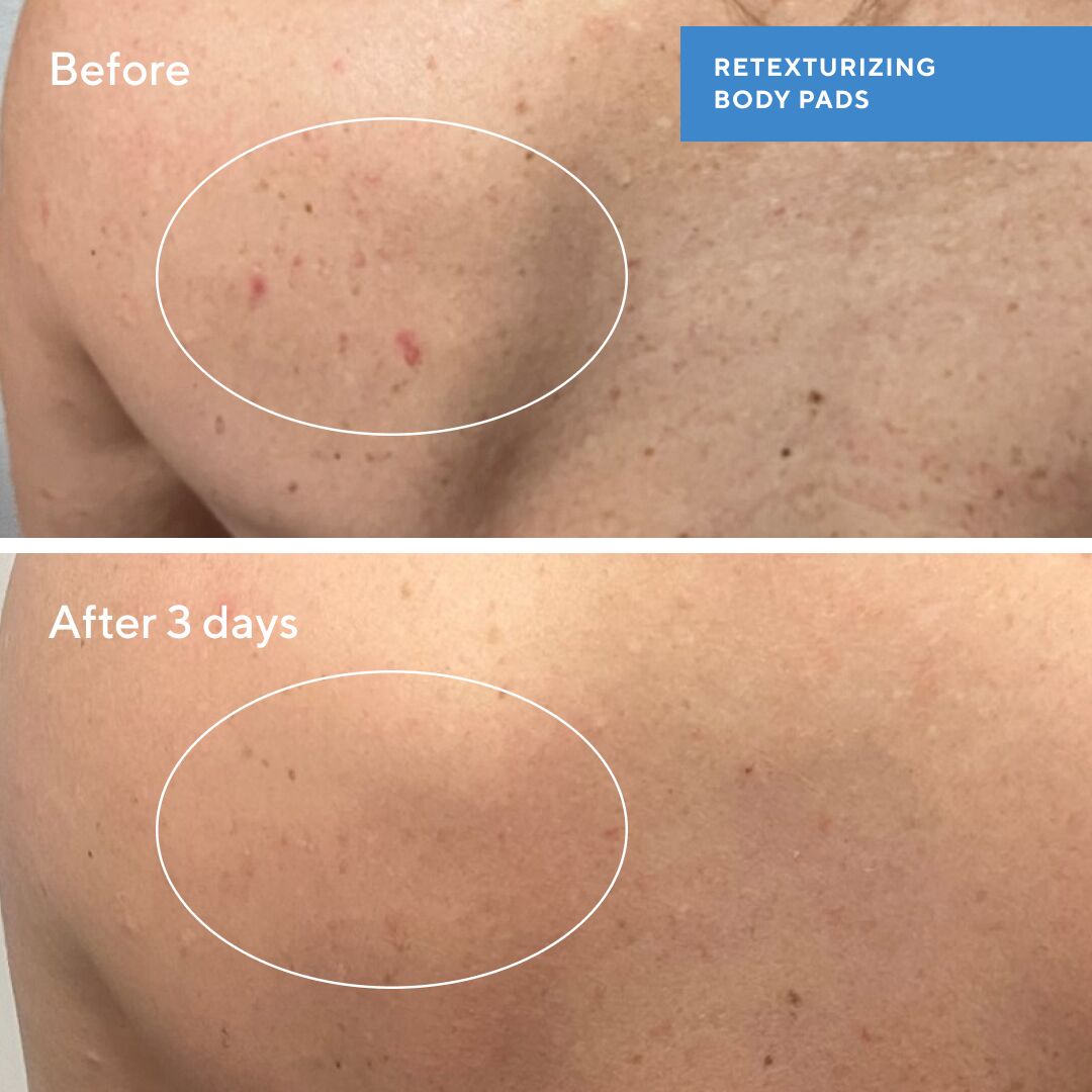 Murad BLEMISH CONTROL - RETEXTURIZING BODY PADS